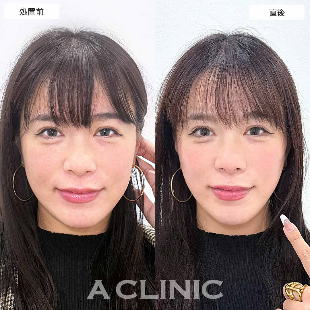 A式美肌たるみ切開でたるみが消えてスッキリ若見え小顔！処置前と直後と3日後の症例です(30代女性）