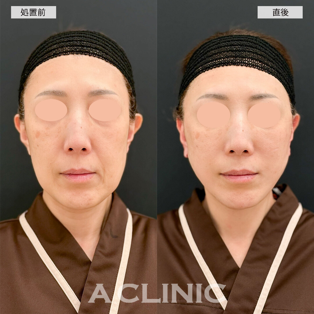 A式美肌たるみ切開なら直後からリフトアップ効果を実感できます！(50代女性)