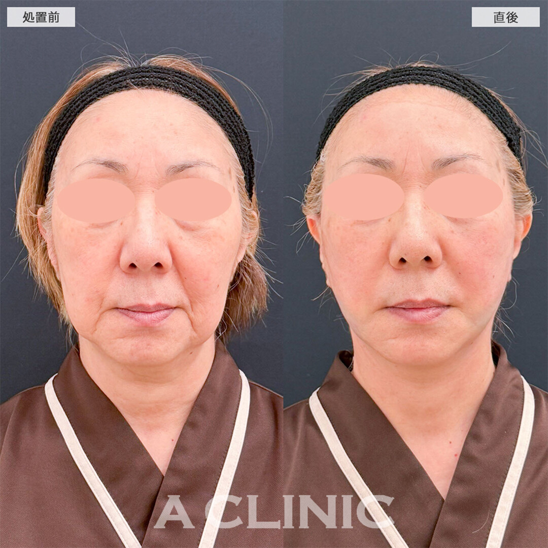 A式美肌たるみ切開と1day小顔脂肪吸引は圧倒的人気の若返り施術！こちら処置前と直後の症例です(60代女性)