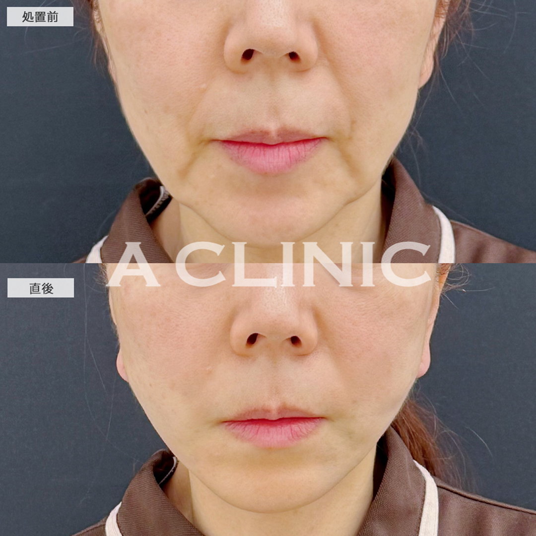 A式美肌たるみ切開と1day小顔脂肪吸引は今一番人気の組み合わせです！こちら処置前と直後の症例です(50代女性)
