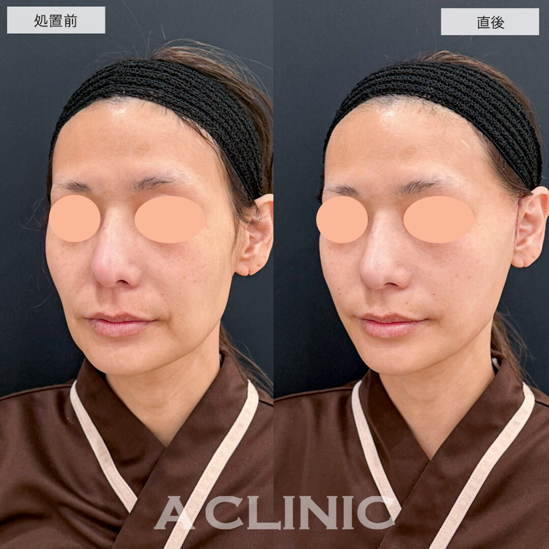 A式美肌たるみ切開で直後から年齢によるたるみが解消しました!こちら処置前と直後の症例です(40代女性)