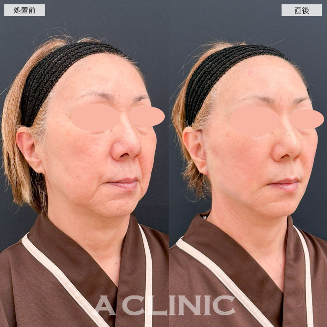 A式美肌たるみ切開と1day小顔脂肪吸引は圧倒的人気の若返り施術！こちら処置前と直後の症例です(60代女性)