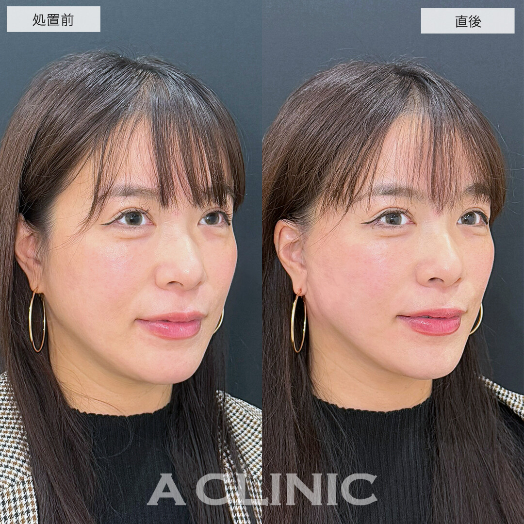 A式美肌たるみ切開でたるみが消えてスッキリ若見え小顔！処置前と直後と3日後の症例です(30代女性）