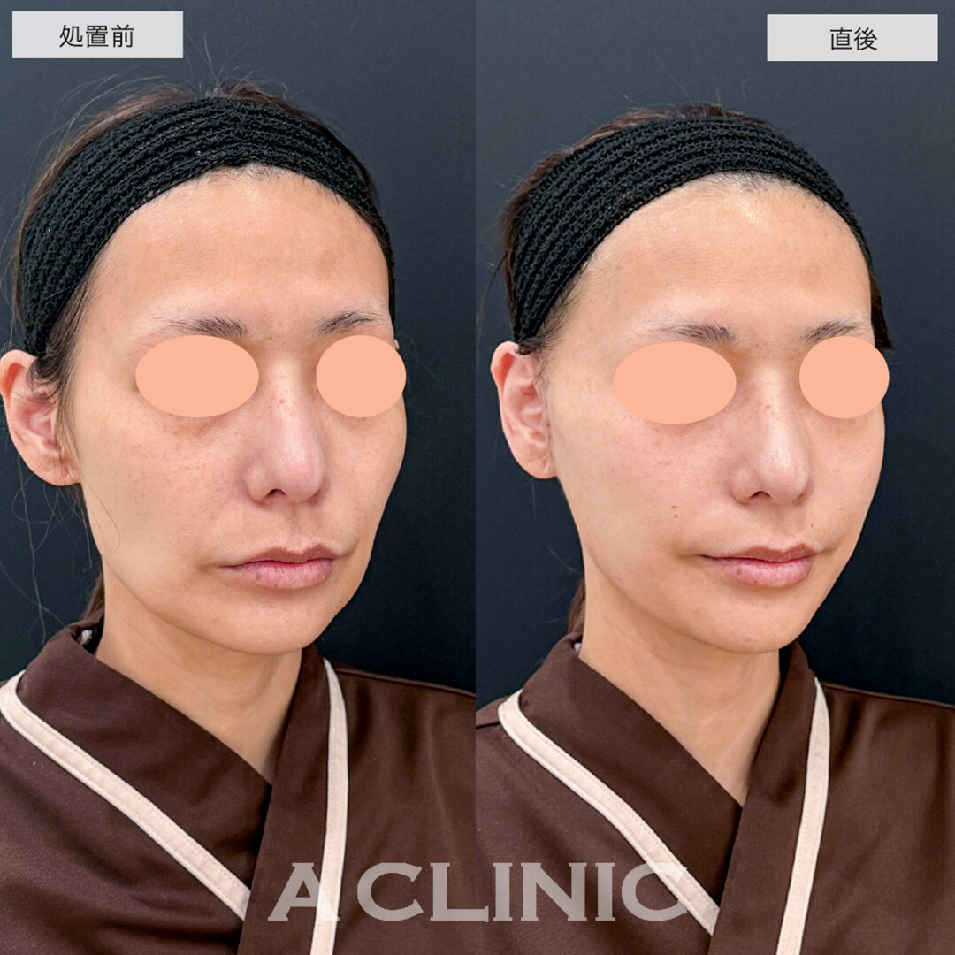 A式美肌たるみ切開で直後から年齢によるたるみが解消しました!こちら処置前と直後の症例です(40代女性)