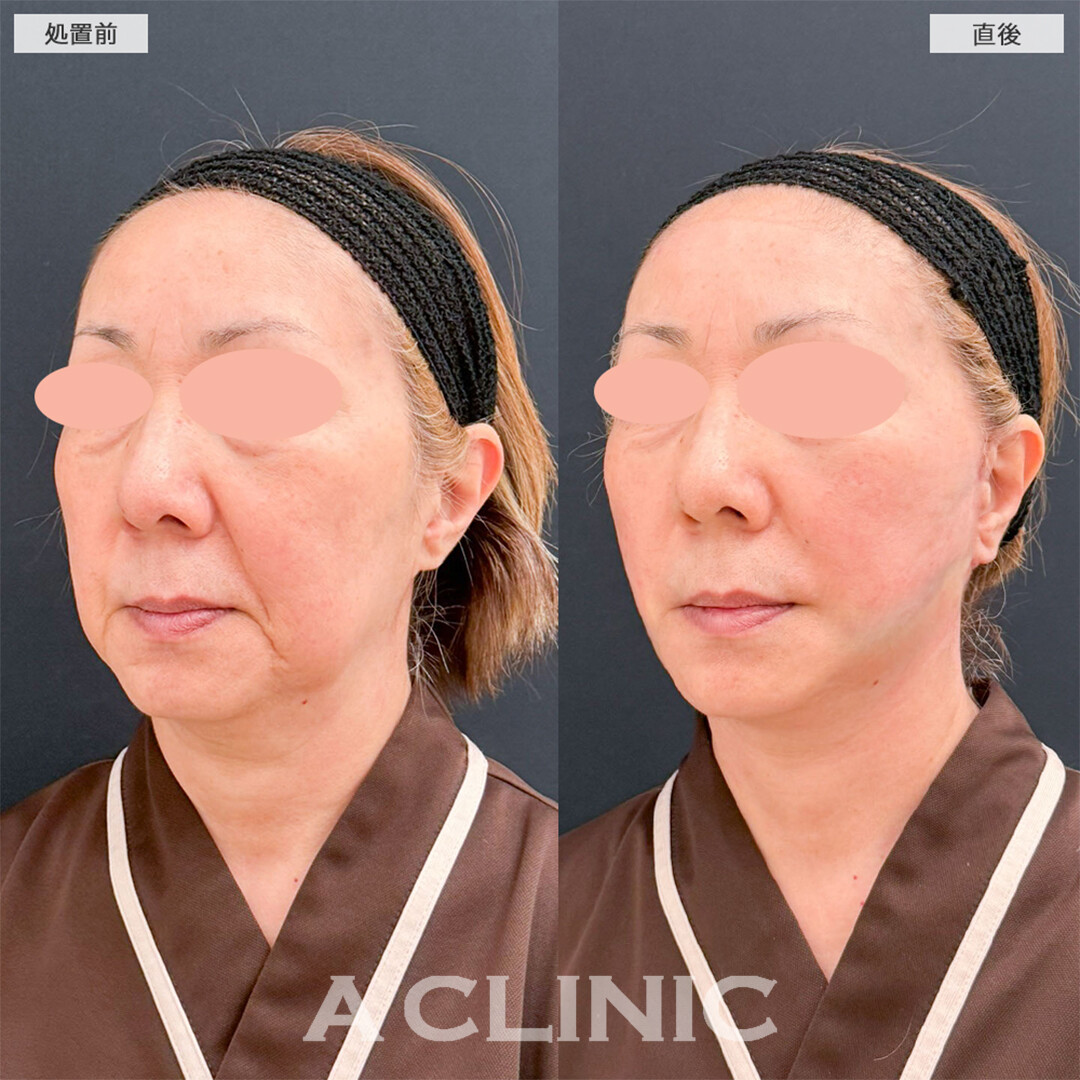 A式美肌たるみ切開と1day小顔脂肪吸引は圧倒的人気の若返り施術！こちら処置前と直後の症例です(60代女性)