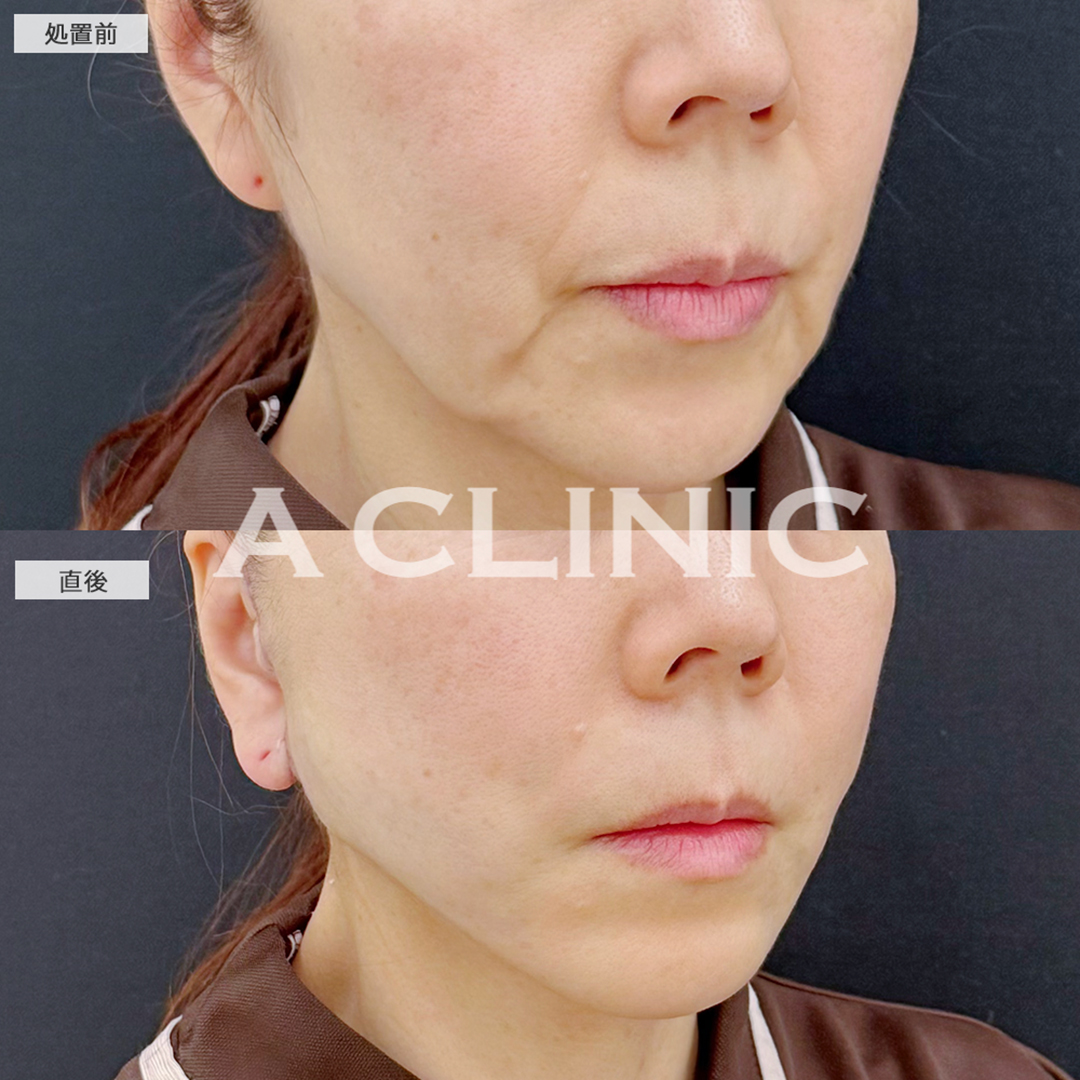 A式美肌たるみ切開と1day小顔脂肪吸引は今一番人気の組み合わせです！こちら処置前と直後の症例です(50代女性)