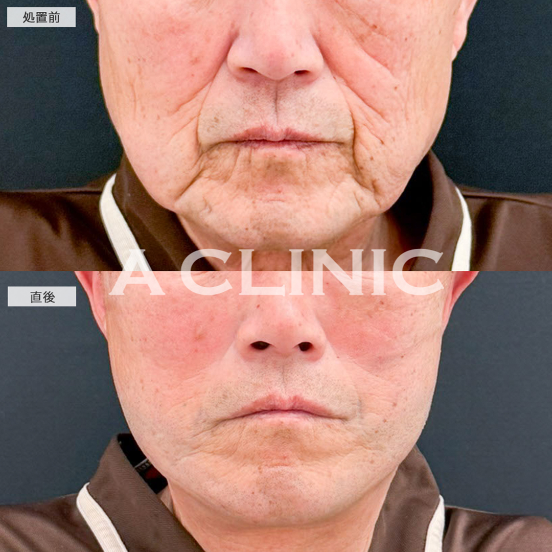A式美肌たるみ切開と1day小顔脂肪吸引は最強の組み合わせ！こちら処置前と直後の症例です(70代男性)