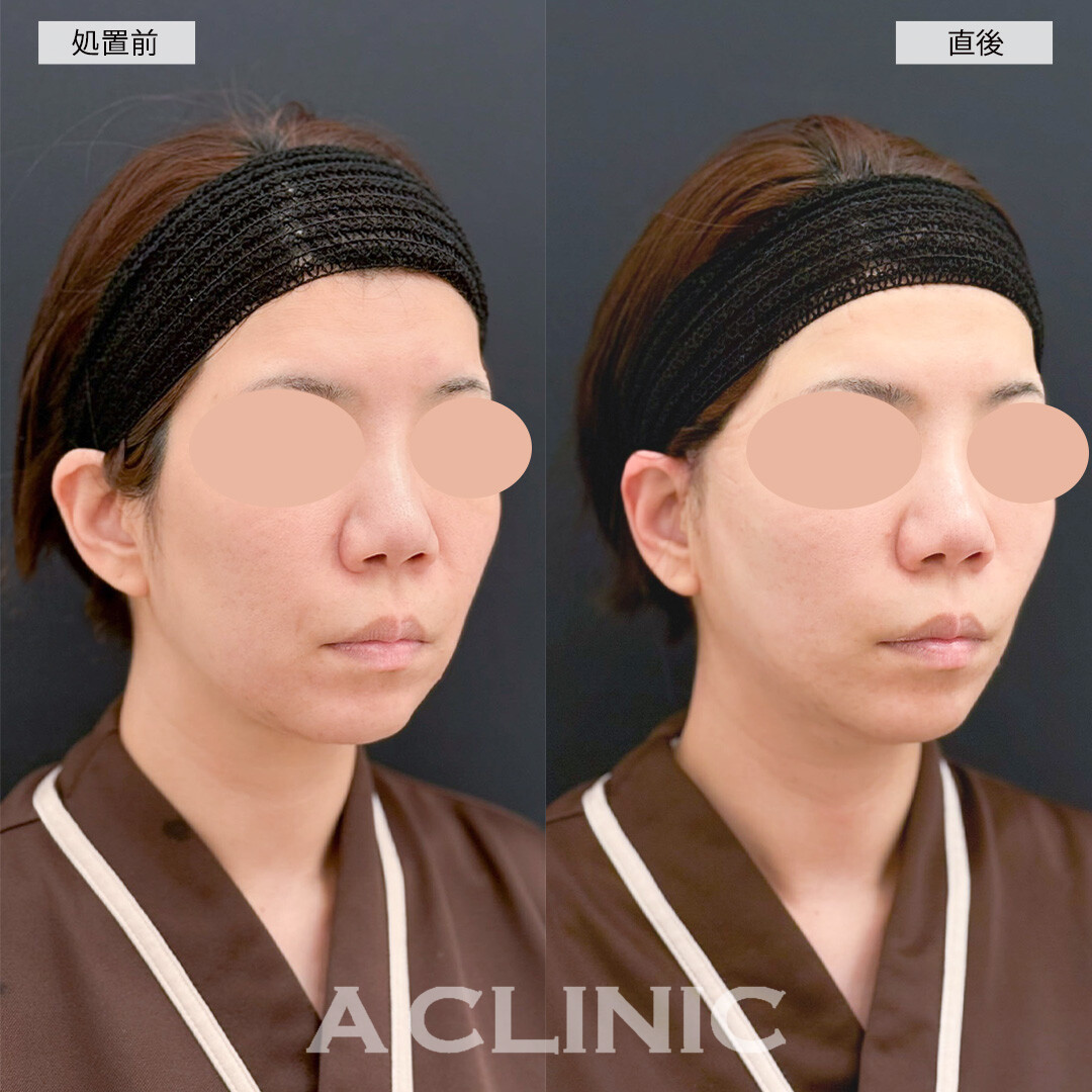 A式美肌たるみ切開はダウンタイムが少なく直後からしっかり引きあがります！こちら処置前と直後の症例です(30代女性)