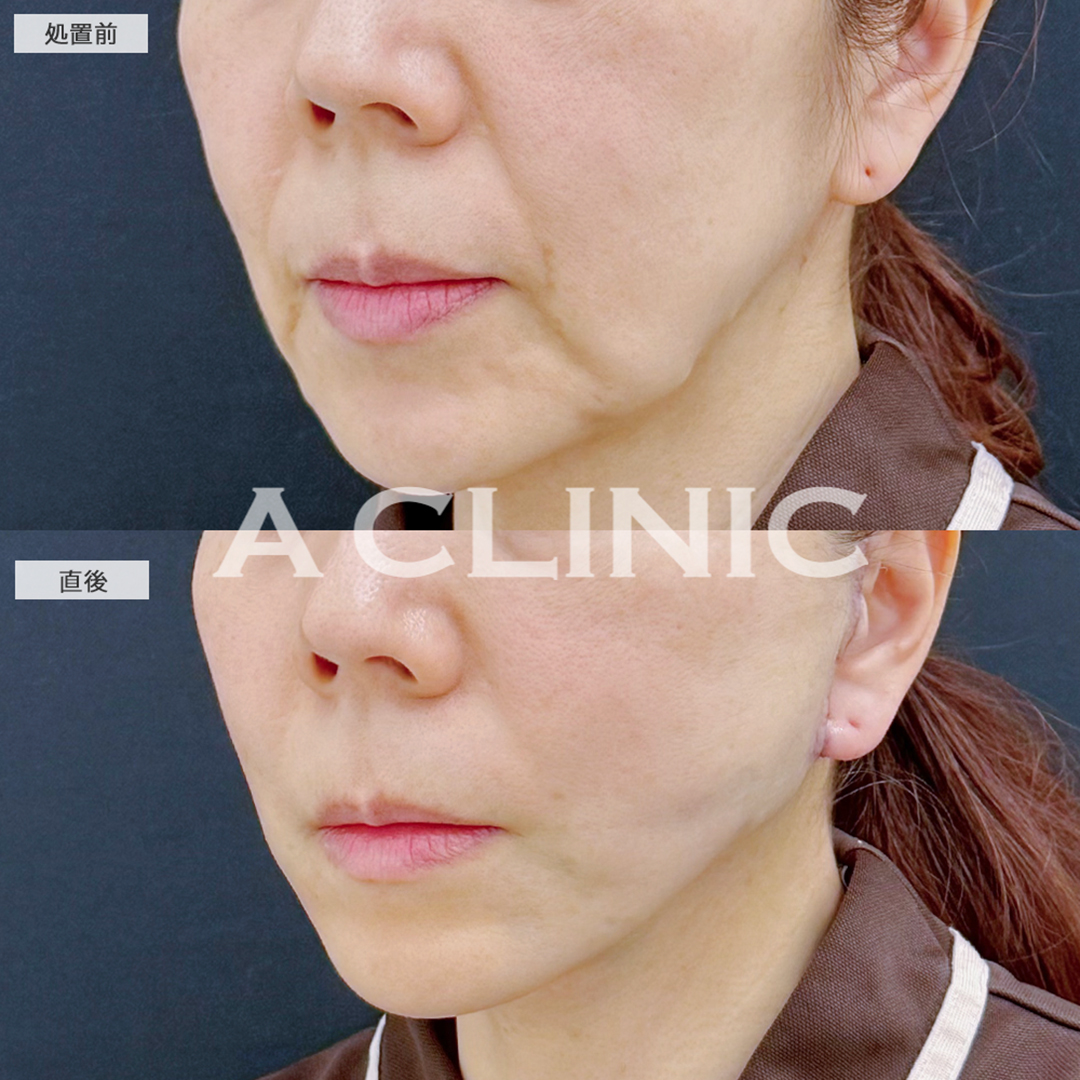 A式美肌たるみ切開と1day小顔脂肪吸引は今一番人気の組み合わせです！こちら処置前と直後の症例です(50代女性)
