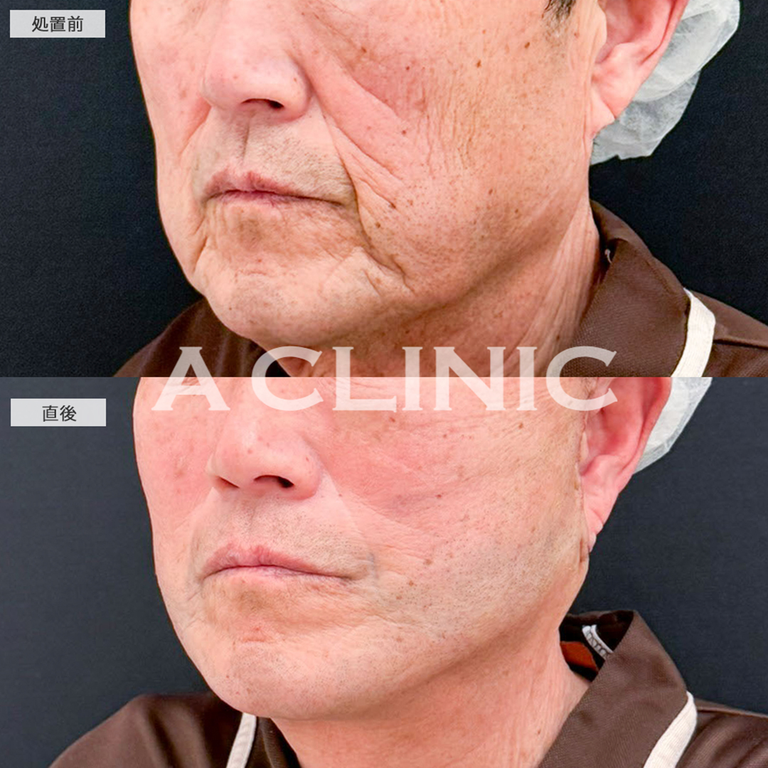 A式美肌たるみ切開と1day小顔脂肪吸引は最強の組み合わせ！こちら処置前と直後の症例です(70代男性)