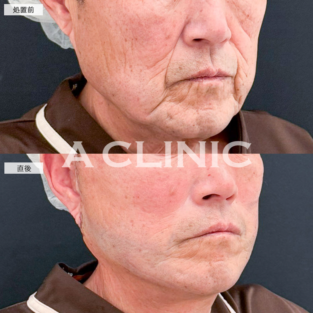 A式美肌たるみ切開と1day小顔脂肪吸引は最強の組み合わせ！こちら処置前と直後の症例です(70代男性)