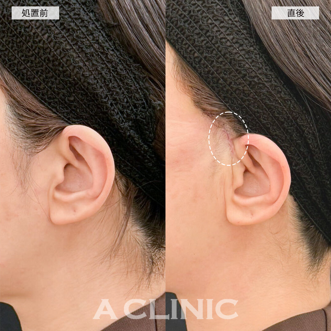 A式美肌たるみ切開はダウンタイムが少なく直後からしっかり引きあがります！こちら処置前と直後の症例です(30代女性)