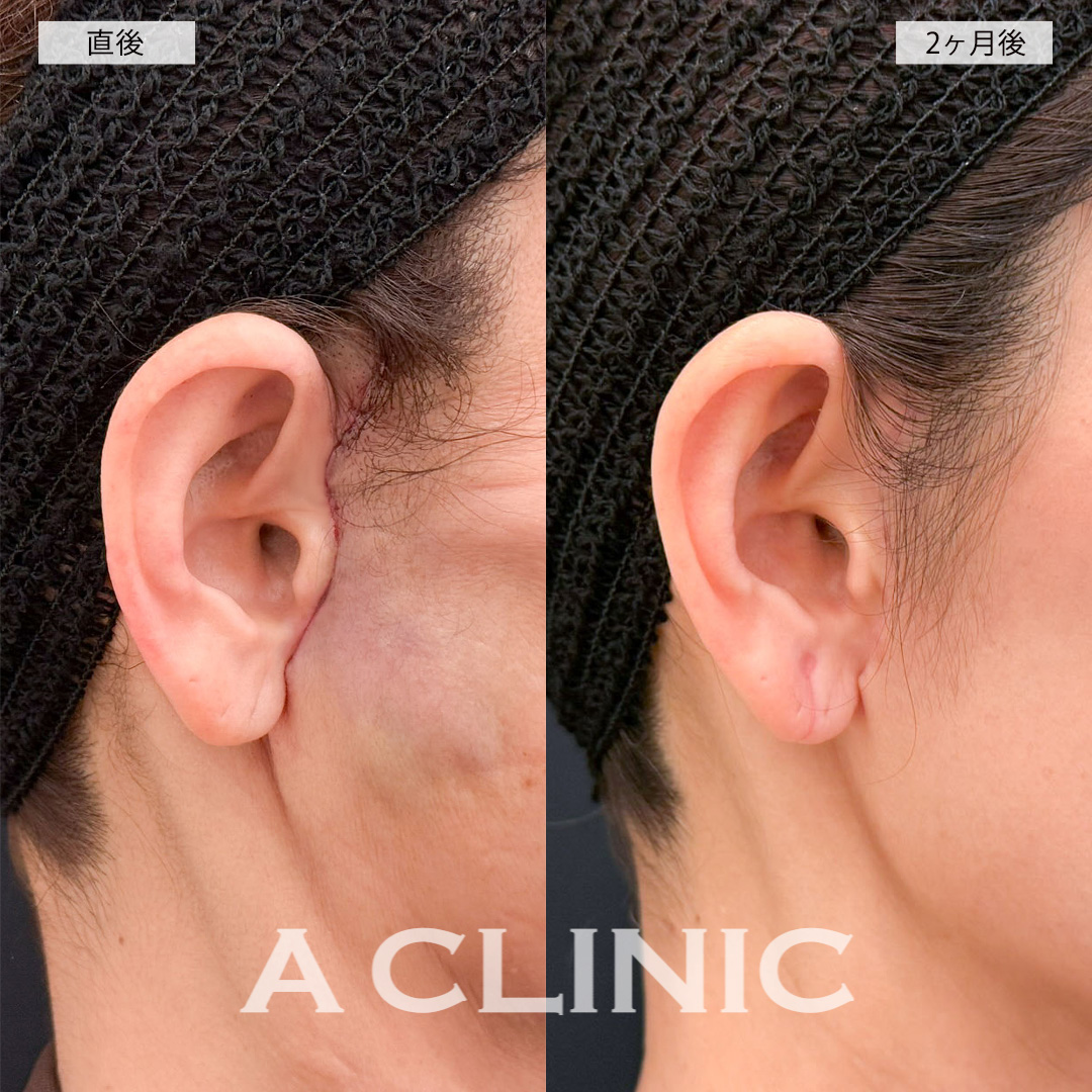 【直後の傷跡あり】A式美肌たるみ切開を行ったことでたるみが改善され自然な若返りに成功！こちら処置前から2ヶ月後までの症例です(40代女性)