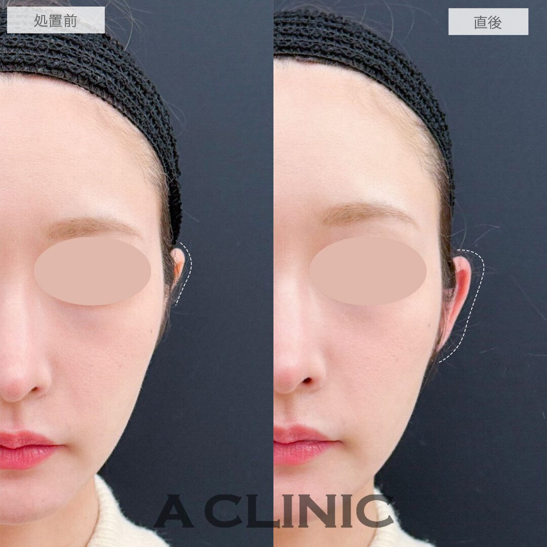 立ち耳ヒアルロン酸注入(ボリューマ)は短時間で小顔効果あり！こちら処置前と直後の症例です(20代女性)