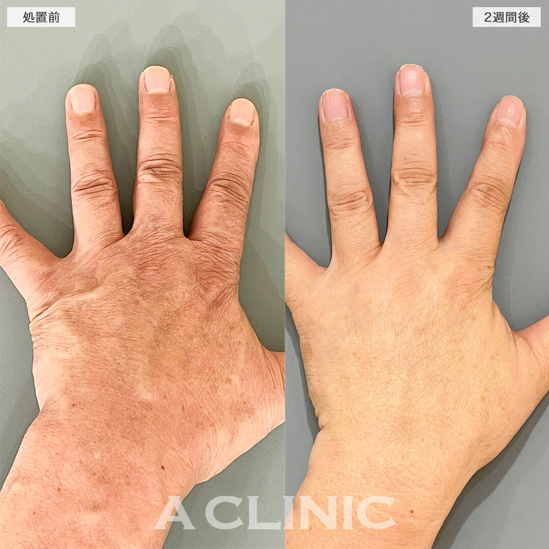 手の甲のヒアルロン酸注入で深く刻まれたシワが改善！処置前と2週間後の症例です(60代男性)