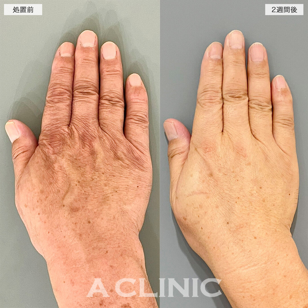 手の甲のヒアルロン酸注入で深く刻まれたシワが改善！処置前と2週間後の症例です(60代男性)