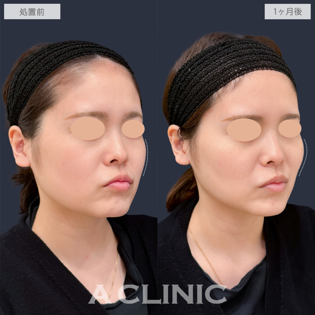 バーティカルリフトで頬を持ち上げ中顔面短縮が叶います！こちら処置前と1か月後の症例です(20代女性)