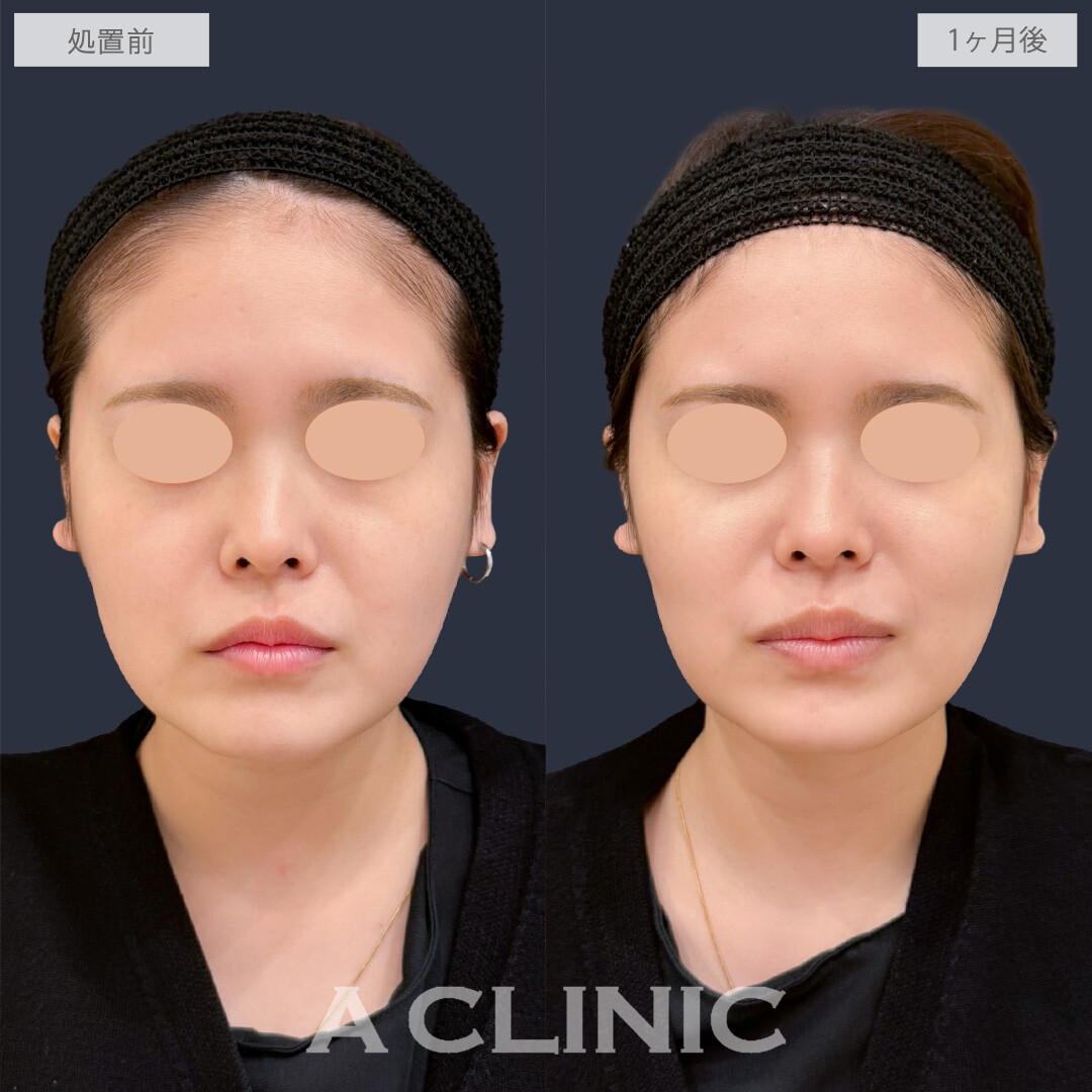 バーティカルリフトで頬を持ち上げ中顔面短縮が叶います！こちら処置前と1か月後の症例です(20代女性)