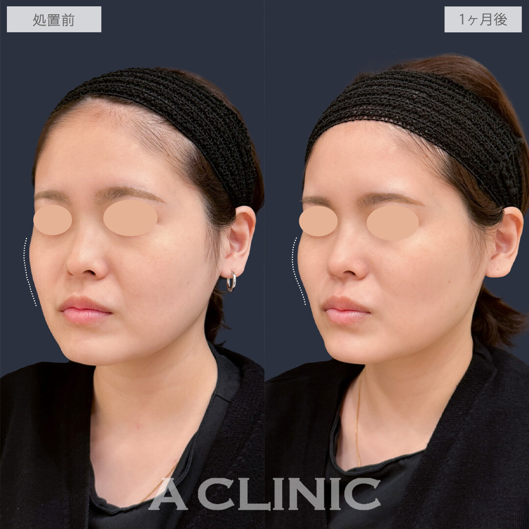 バーティカルリフトで頬を持ち上げ中顔面短縮が叶います！こちら処置前と1か月後の症例です(20代女性)