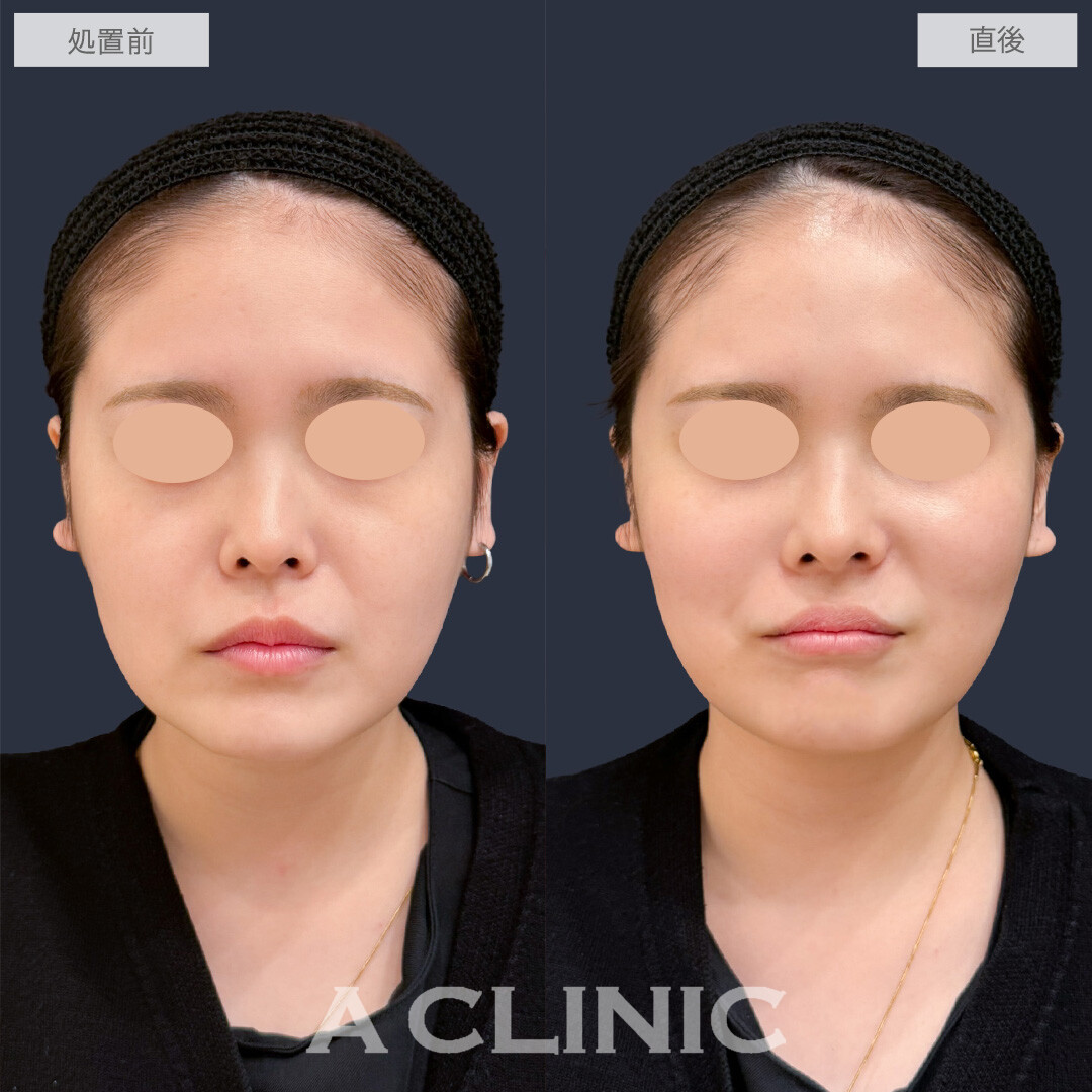 バーティカルリフトで頬を持ち上げ笑顔がより映えるお顔に！こちら処置前と直後の症例です(20代女性)