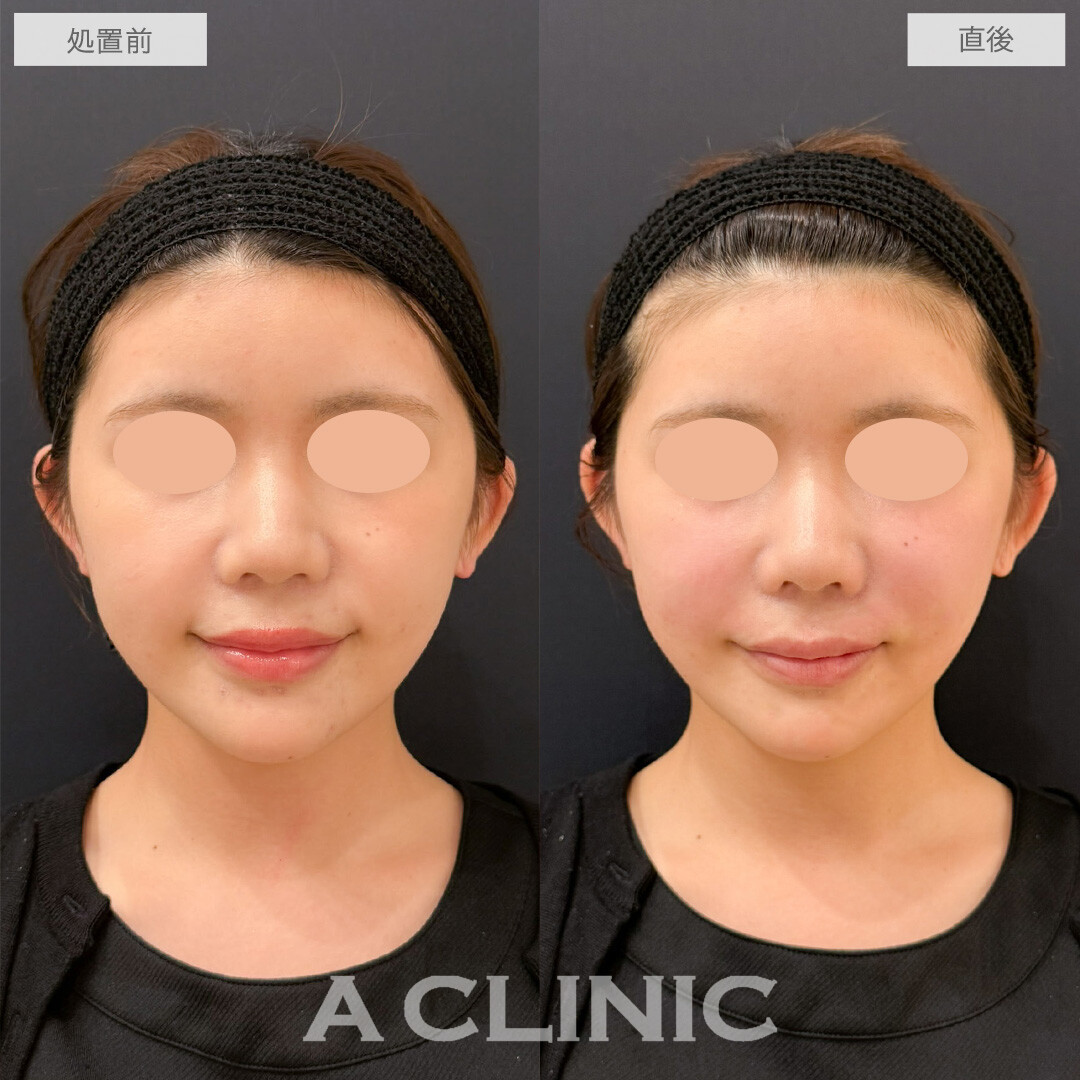 バーティカルリフトでチークトップが上がりかわいらしい印象になりました！こちら処置前と直後の症例です(20代女性)