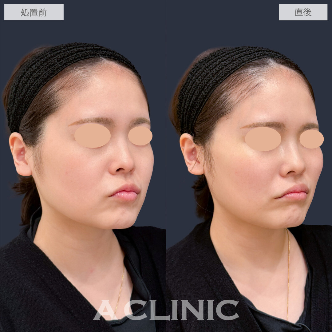 バーティカルリフトで頬を持ち上げ笑顔がより映えるお顔に！こちら処置前と直後の症例です(20代女性)