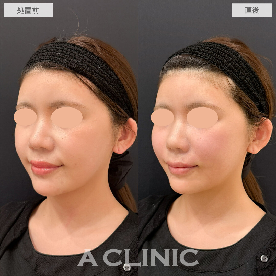 バーティカルリフトでチークトップが上がりかわいらしい印象になりました！こちら処置前と直後の症例です(20代女性)