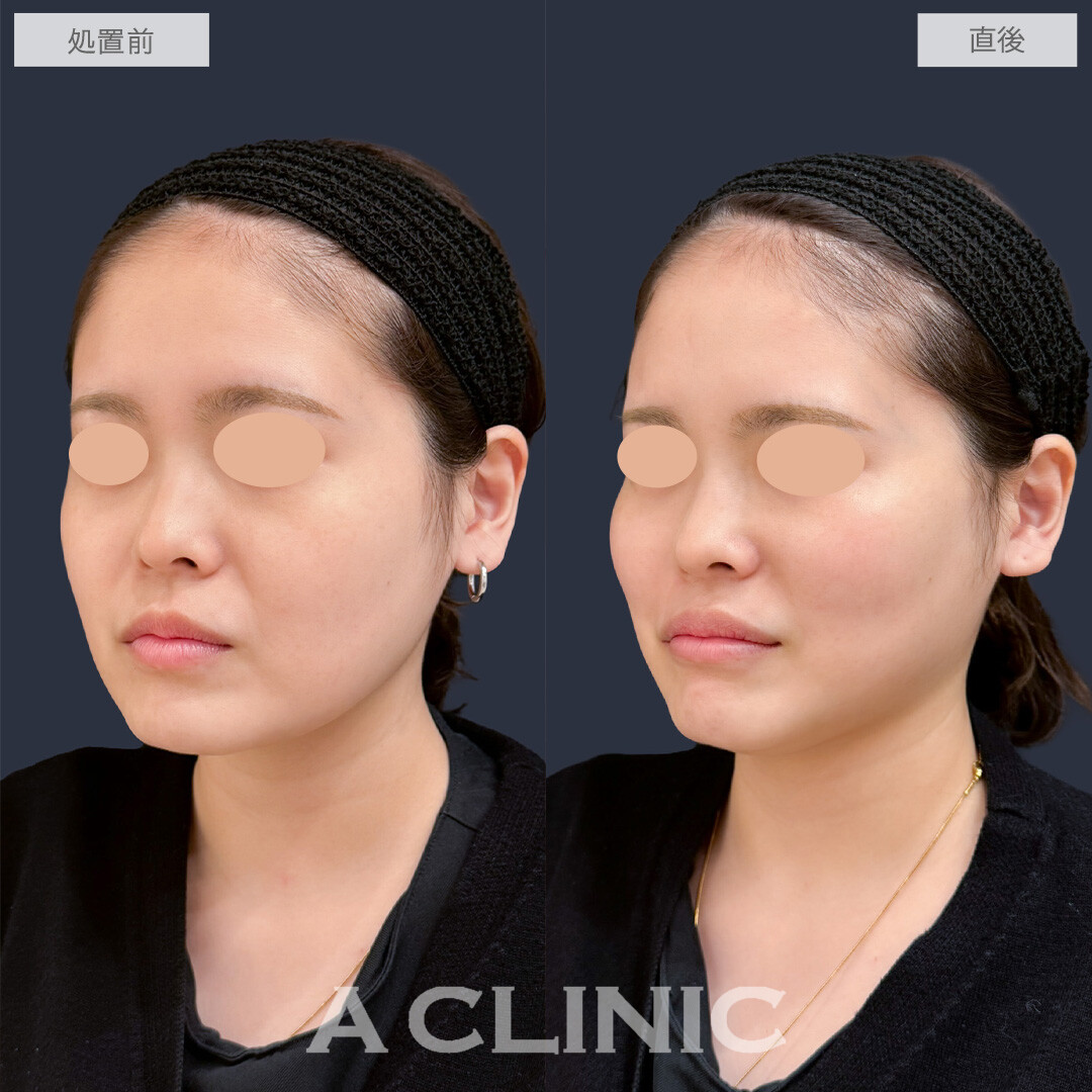 バーティカルリフトで頬を持ち上げ笑顔がより映えるお顔に！こちら処置前と直後の症例です(20代女性)