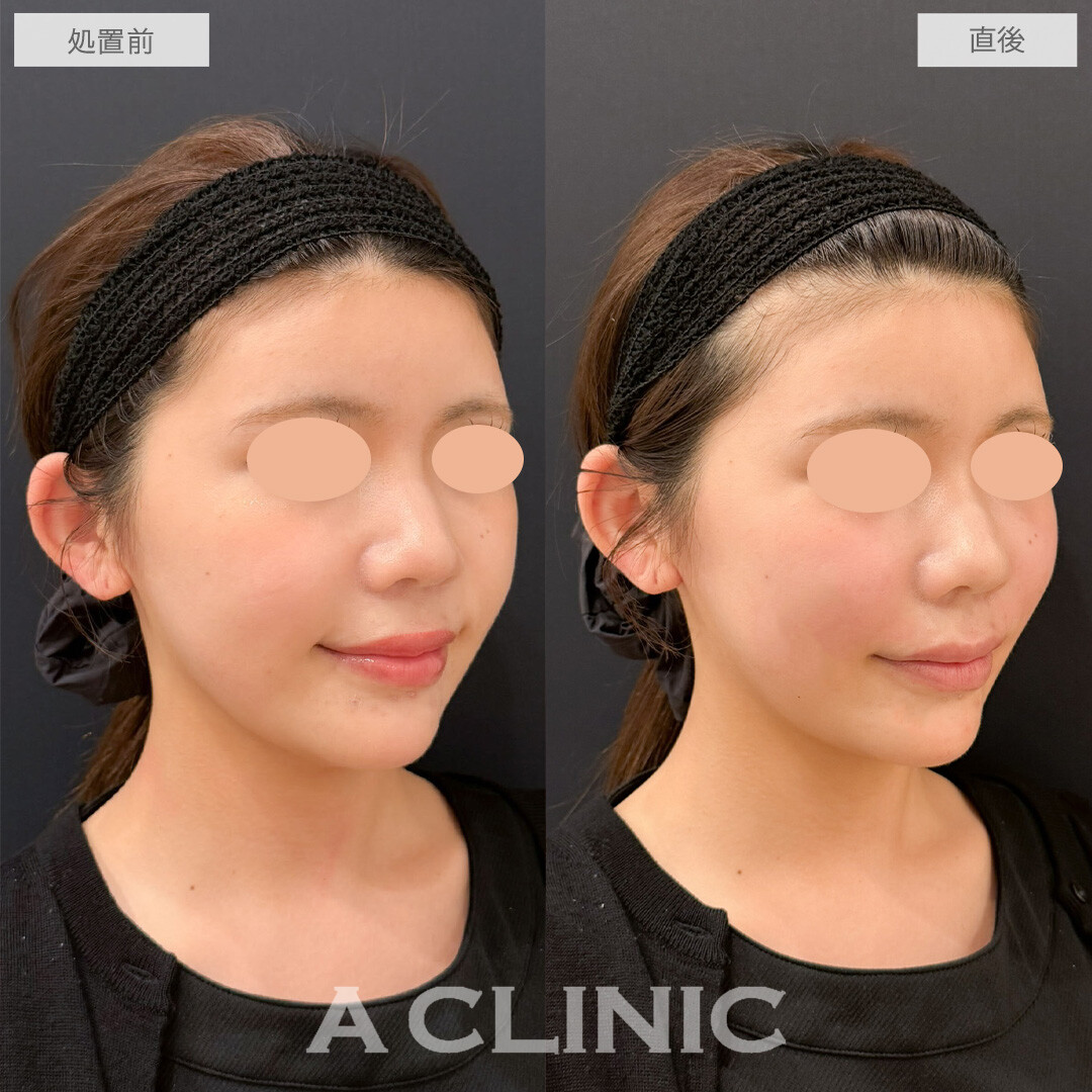 バーティカルリフトでチークトップが上がりかわいらしい印象になりました！こちら処置前と直後の症例です(20代女性)