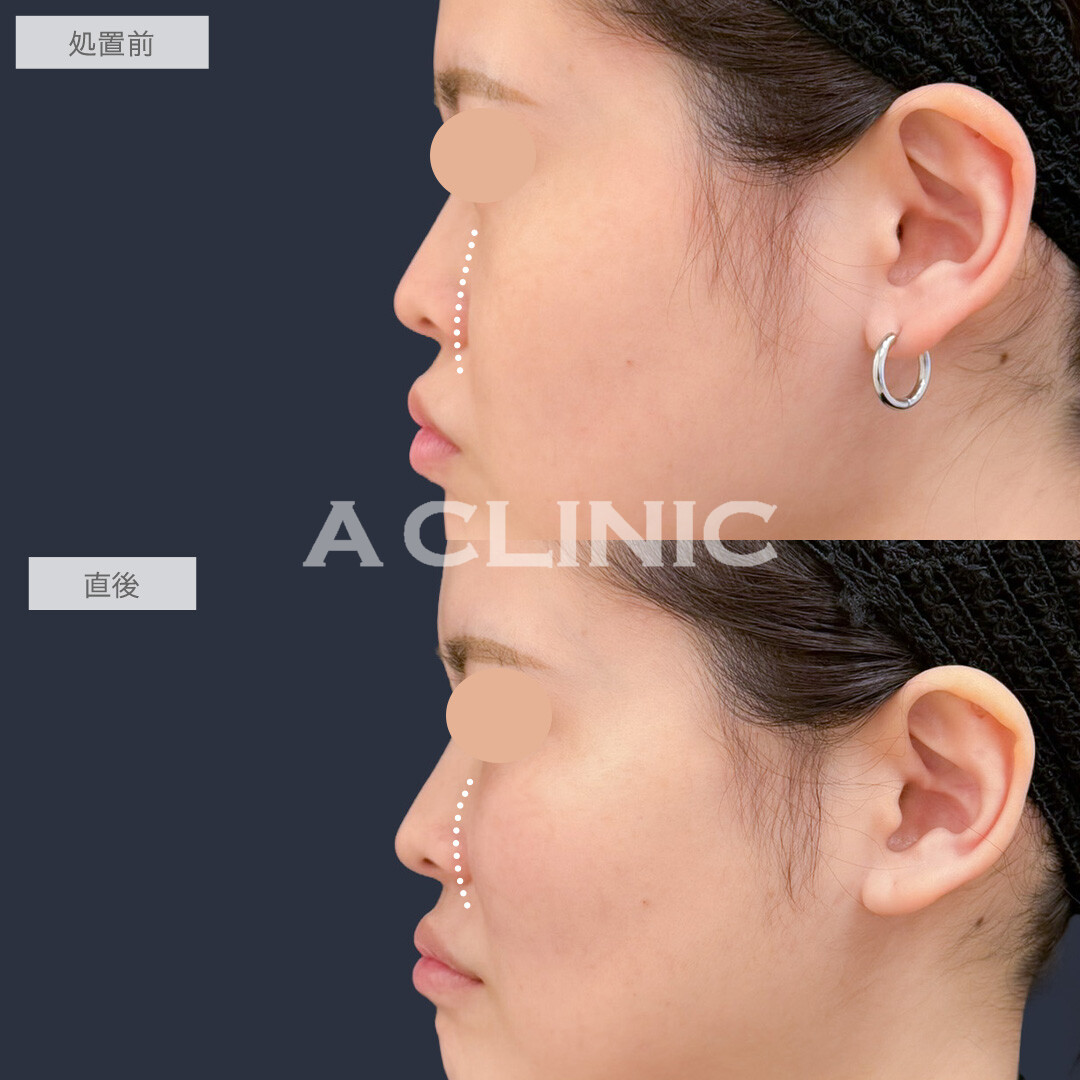 バーティカルリフトで頬を持ち上げ笑顔がより映えるお顔に！こちら処置前と直後の症例です(20代女性)