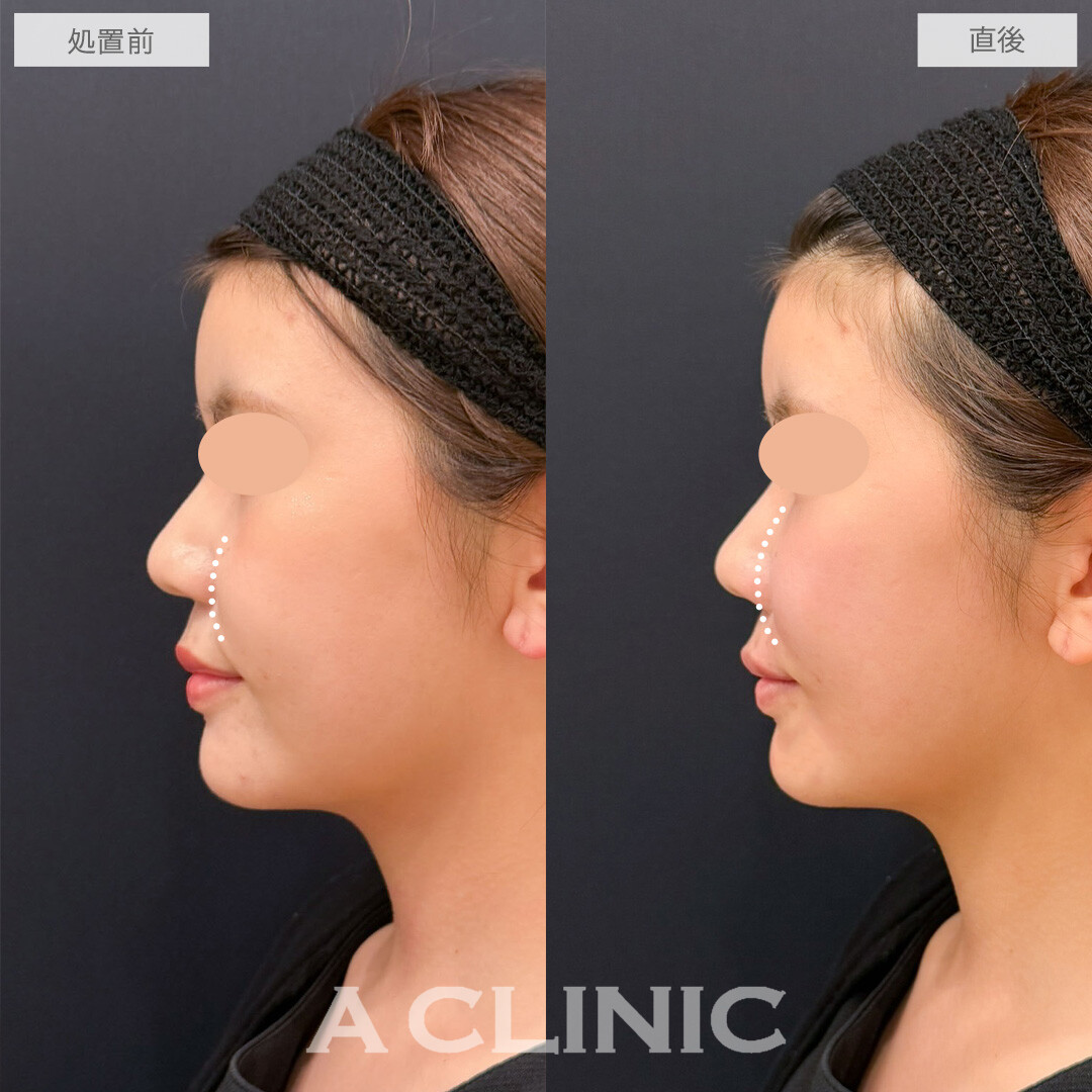 バーティカルリフトでチークトップが上がりかわいらしい印象になりました！こちら処置前と直後の症例です(20代女性)