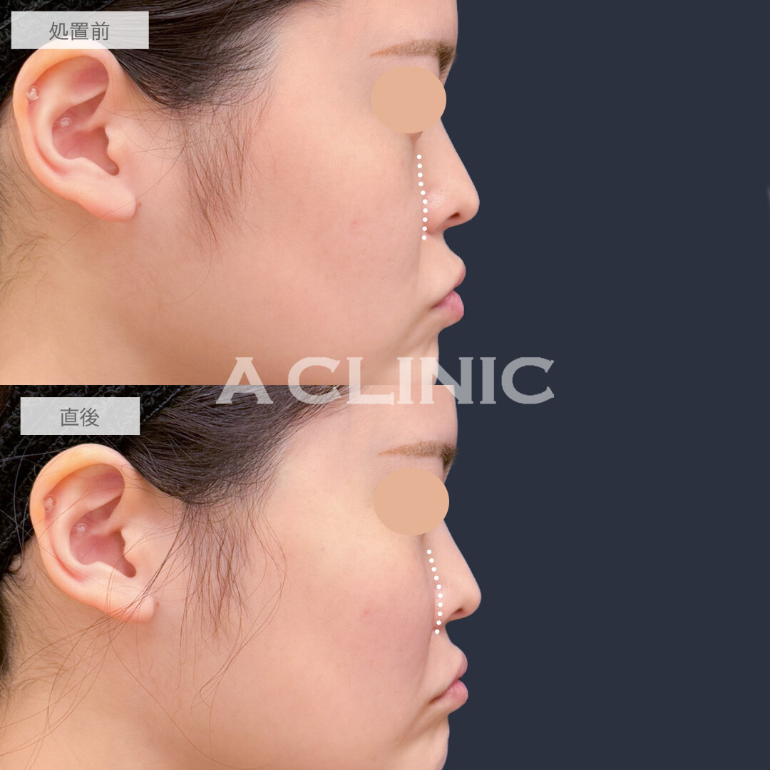 バーティカルリフトで頬を持ち上げ笑顔がより映えるお顔に！こちら処置前と直後の症例です(20代女性)