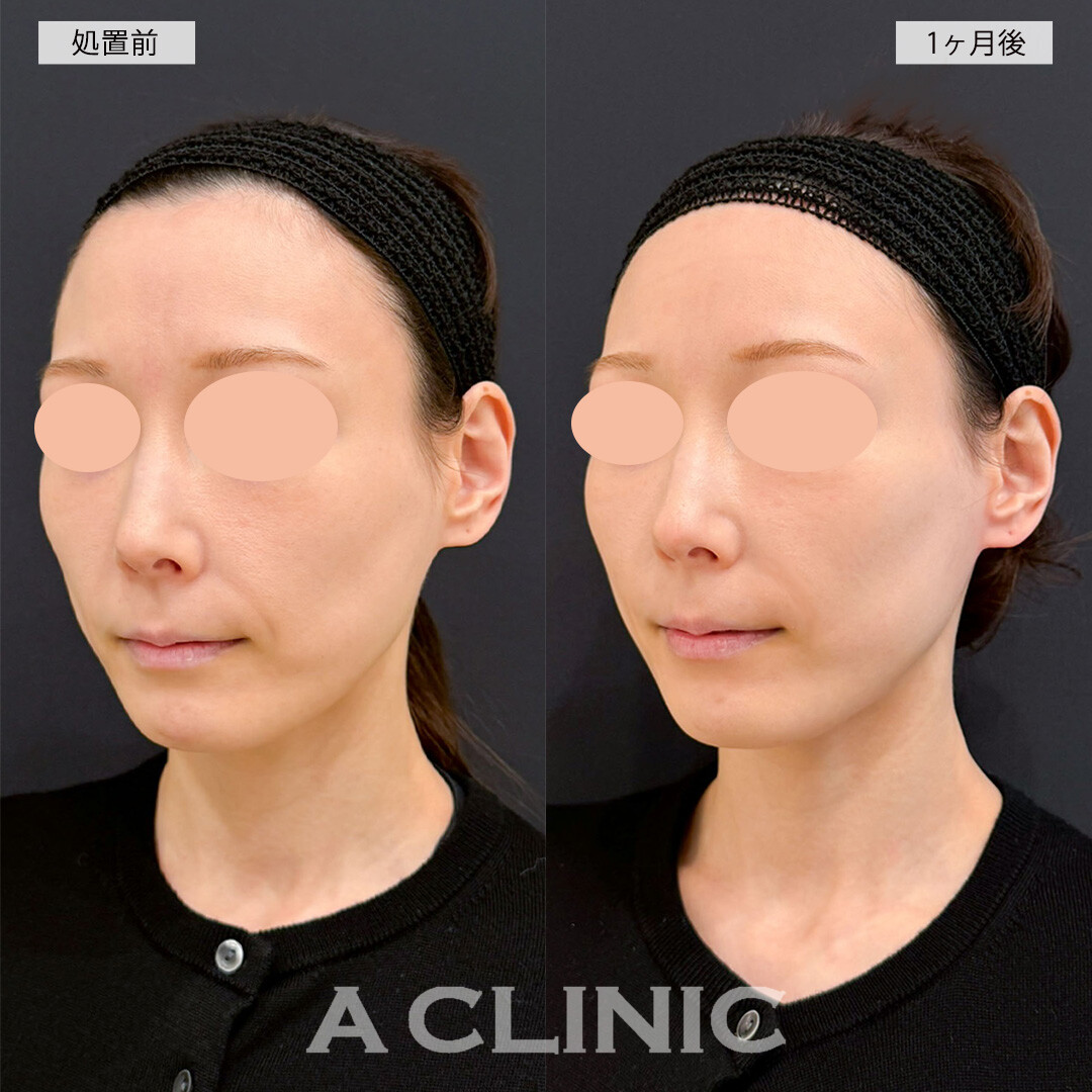 Aスレッドとバーティカルリフトでナチュラルに中顔面短縮！こちら処置前と直後の症例です(20代女性)
