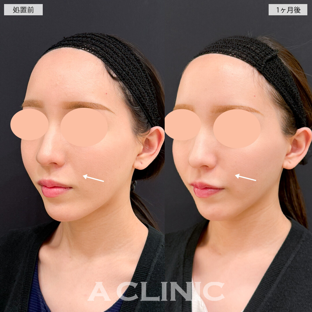 バーティカルリフトで中顔面のたるみが目立たなくなると一気に垢抜けます！処置前と1ヶ月後の症例です(20代女性)