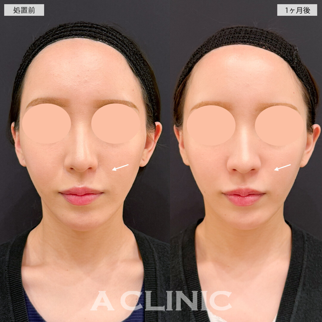 バーティカルリフトで中顔面のたるみが目立たなくなると一気に垢抜けます！処置前と1ヶ月後の症例です(20代女性)