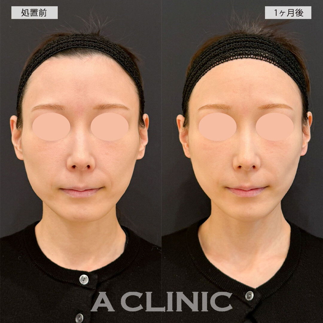 Aスレッドとバーティカルリフトでナチュラルに中顔面短縮！こちら処置前と直後の症例です(20代女性)
