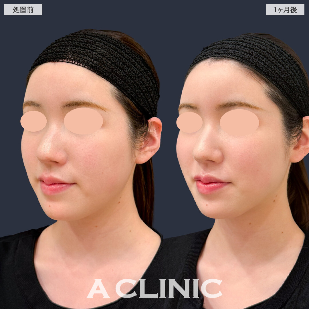 バーティカルリフトで頬の位置が上がって多幸感が増しました！こちら処置前と1か月後の症例です(20代女性)