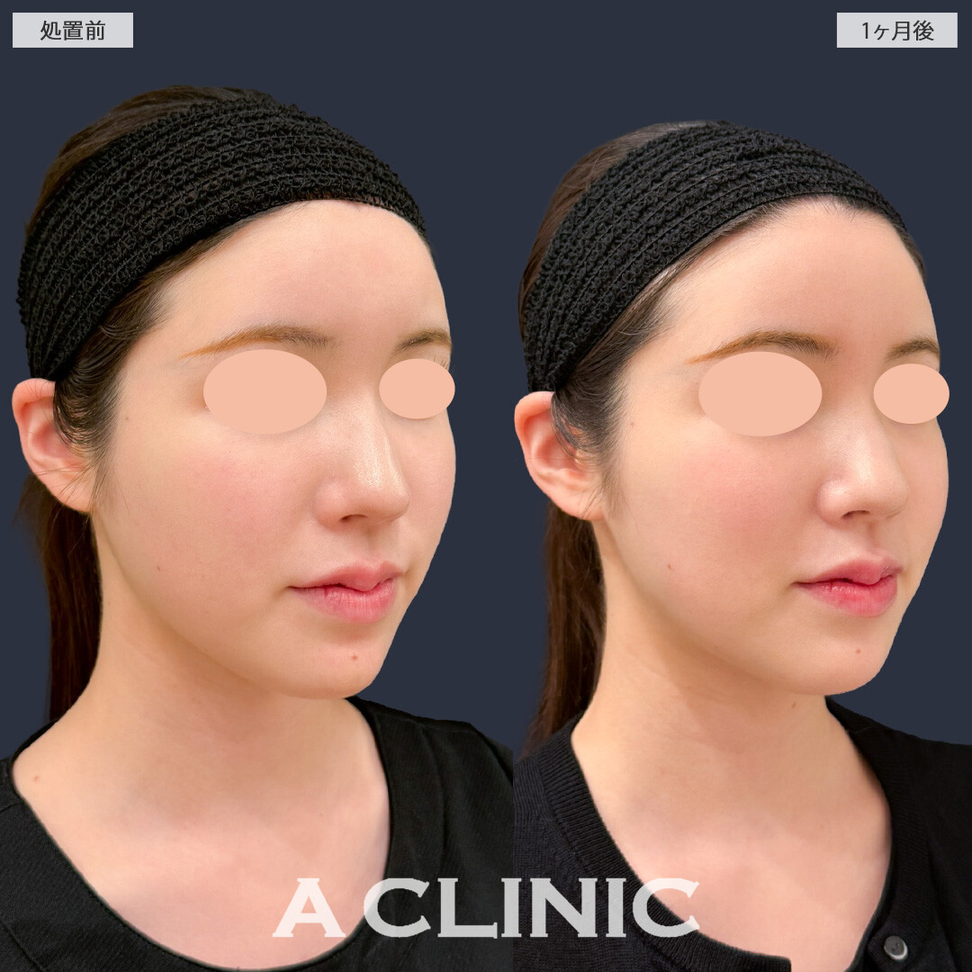 バーティカルリフトで頬の位置が上がって多幸感が増しました！こちら処置前と1か月後の症例です(20代女性)