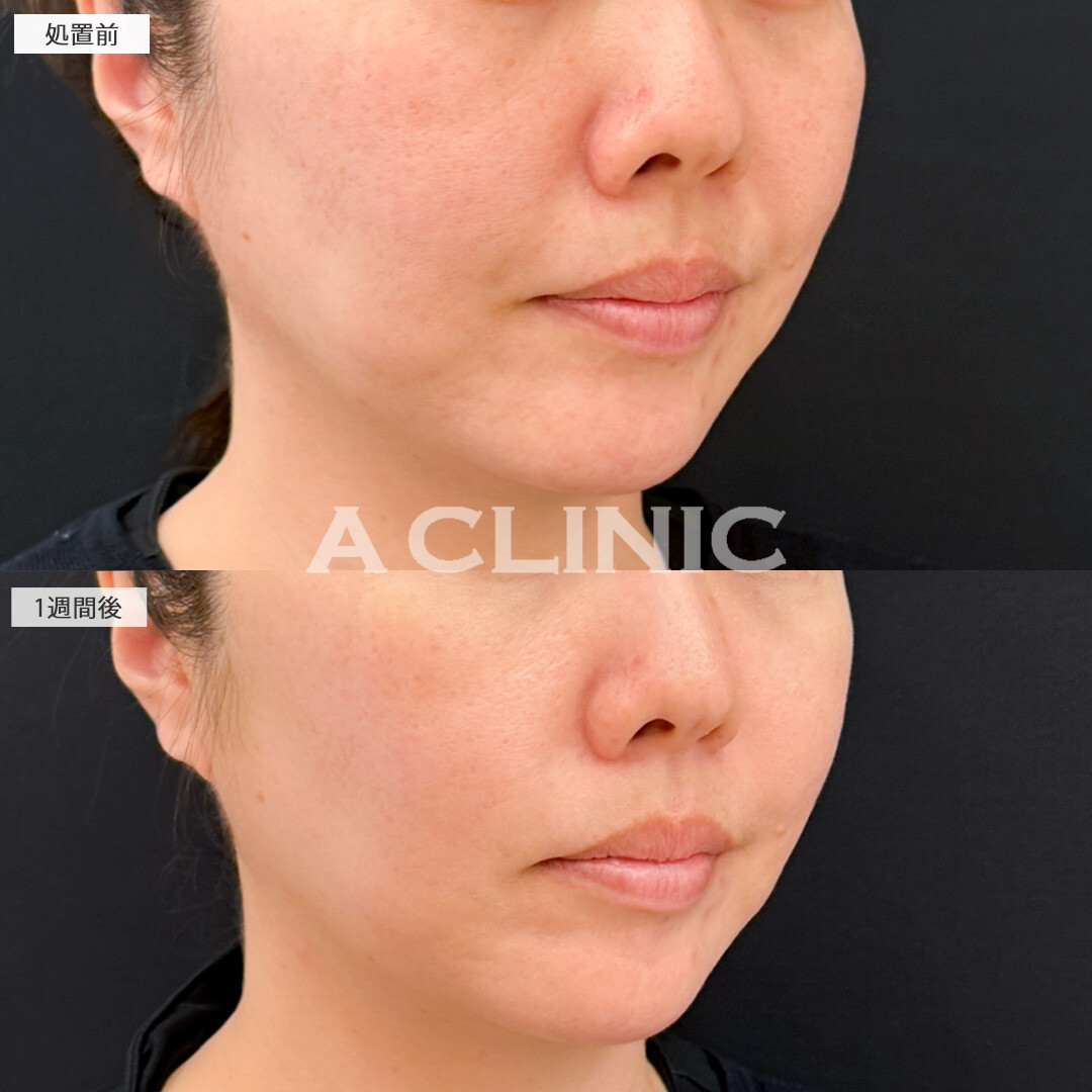 バーティカルリフトで垂れ下がりやすい頬をグイッと引き上げ！処置前と1週間後の症例です(30代女性)