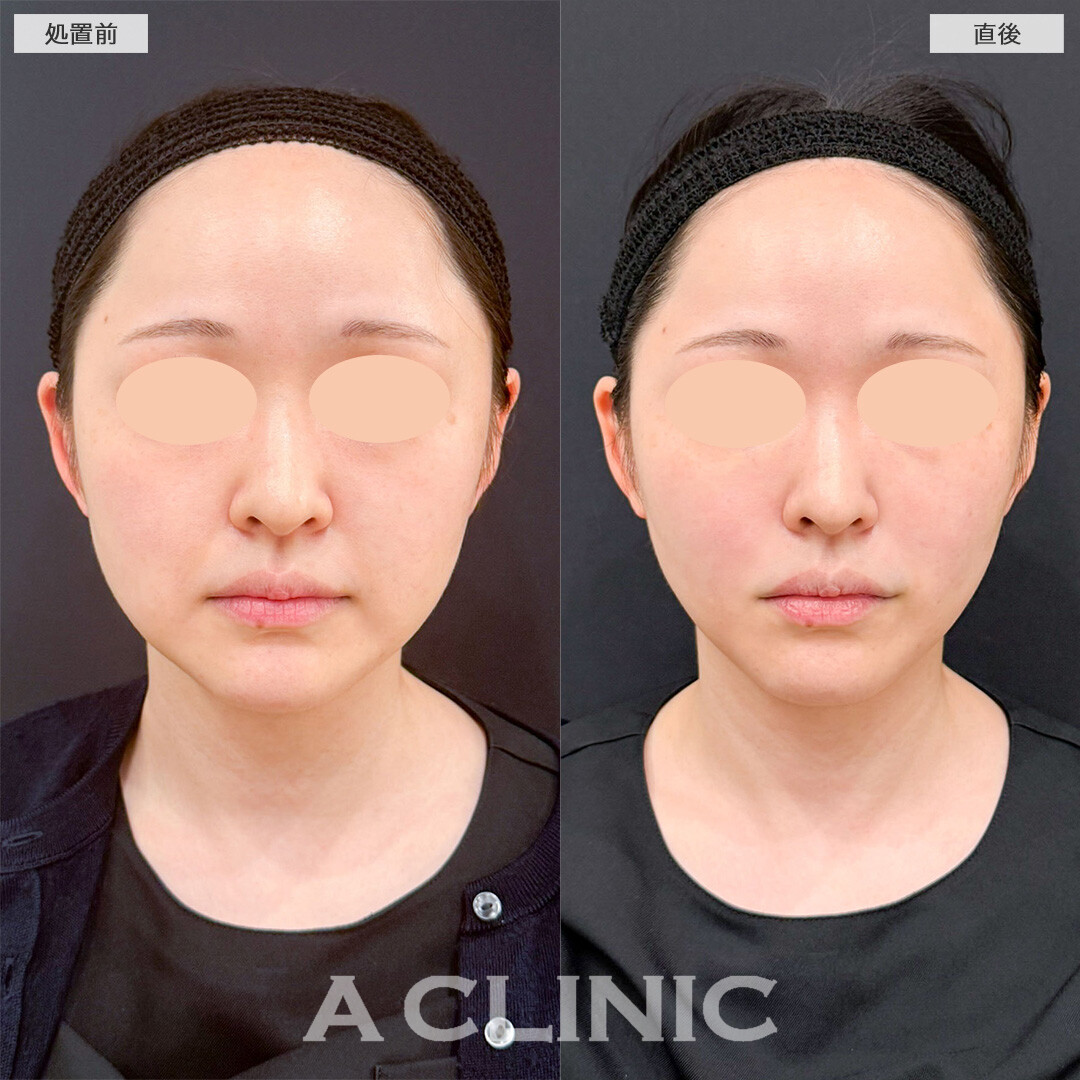 バーティカルリフトならほうれい線のお悩みへ直接アプローチして若見えが叶う！こちら処置前と直後の症例です(20代女性)