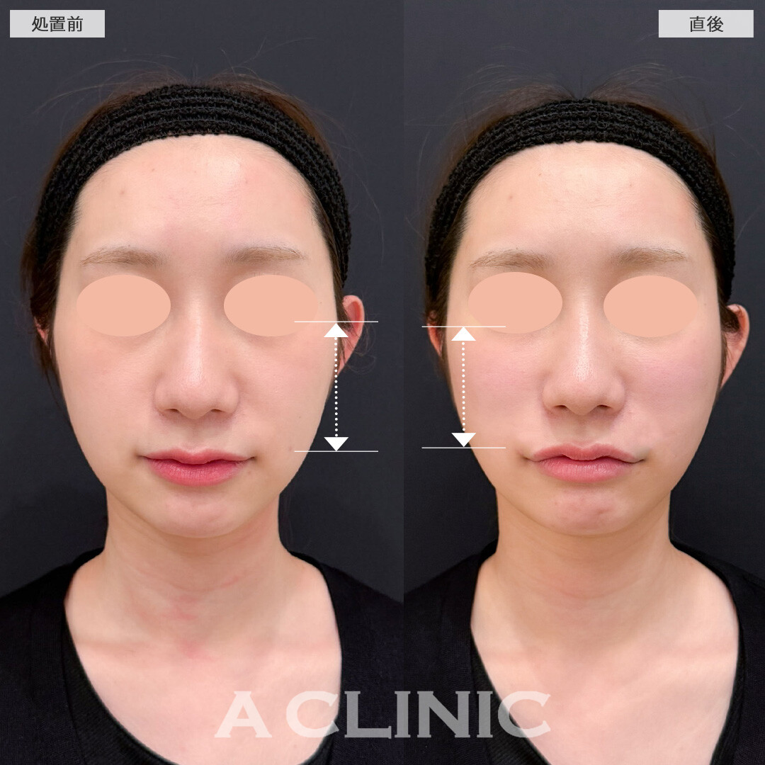 バーティカルリフトでチークトップが持ち上げ中顔面短縮しながら立体的な印象に！こちら処置前と直後の症例です(20代女性)