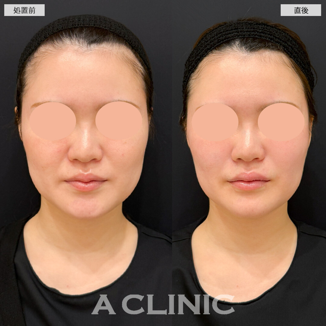 バーティカルリフトで頬がキュッと引きあがり表情もよく見えるようになりました！処置前と直後の症例です(30代女性)