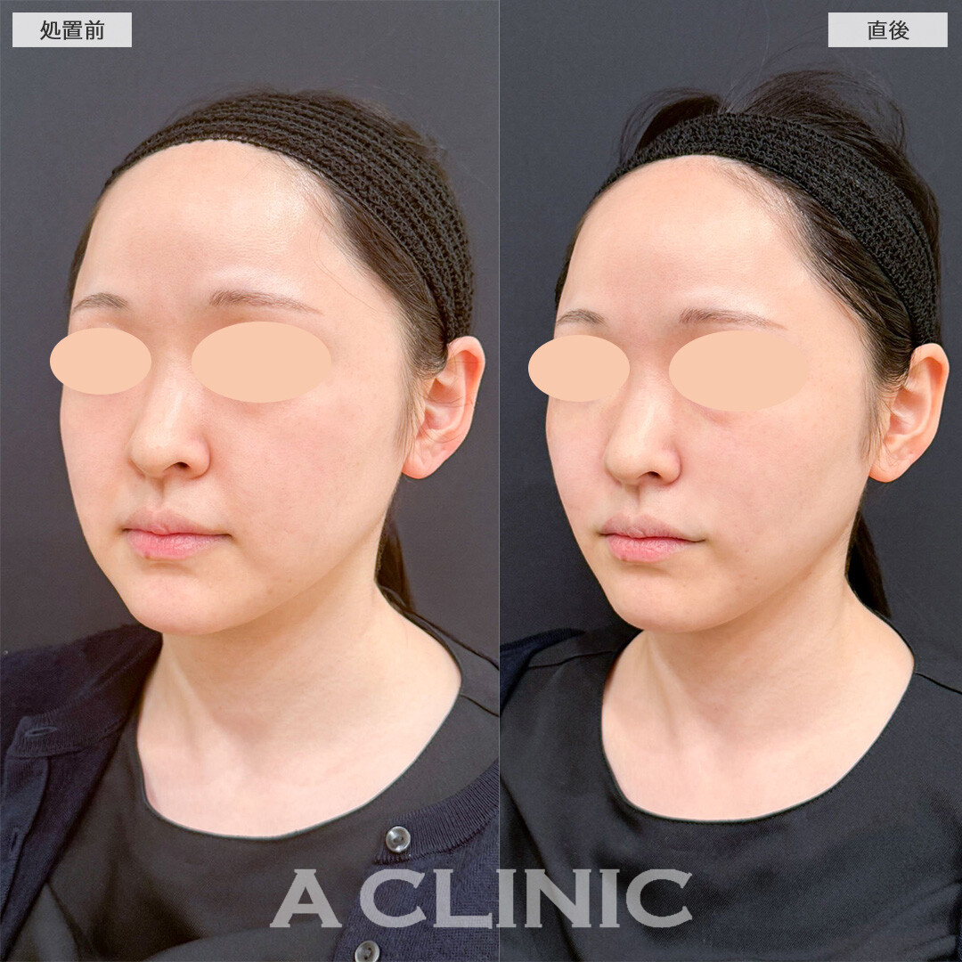 バーティカルリフトならほうれい線のお悩みへ直接アプローチして若見えが叶う！こちら処置前と直後の症例です(20代女性)
