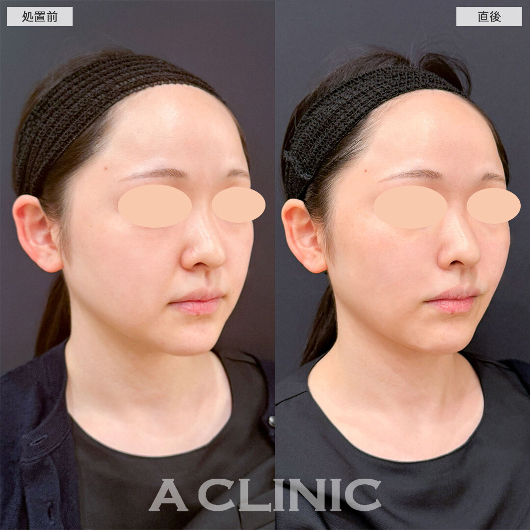 バーティカルリフトならほうれい線のお悩みへ直接アプローチして若見えが叶う！こちら処置前と直後の症例です(20代女性)