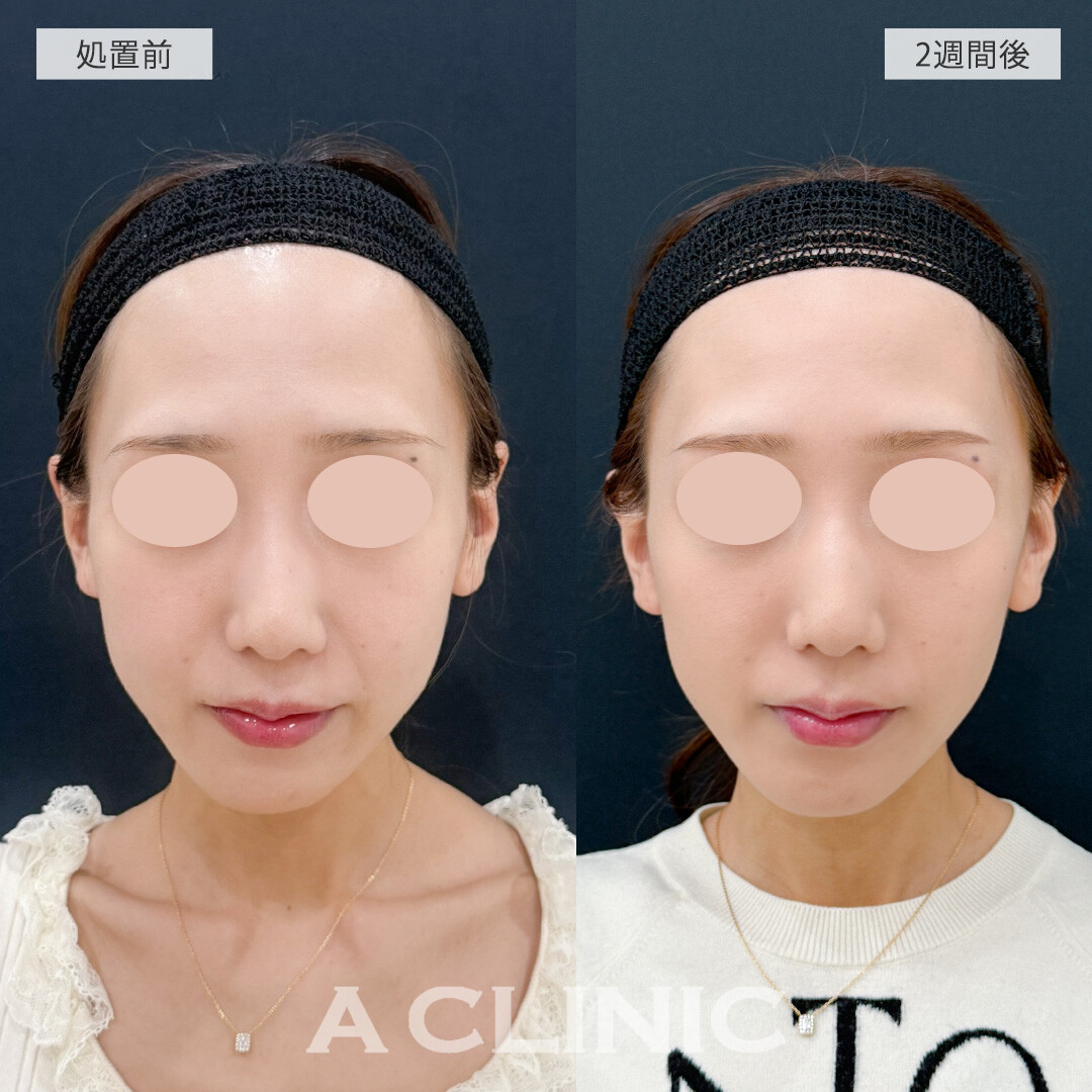 Aスレッドとバーティカルリフトで中顔面短縮！こちら処置前と2週間後の症例です(30代女性)