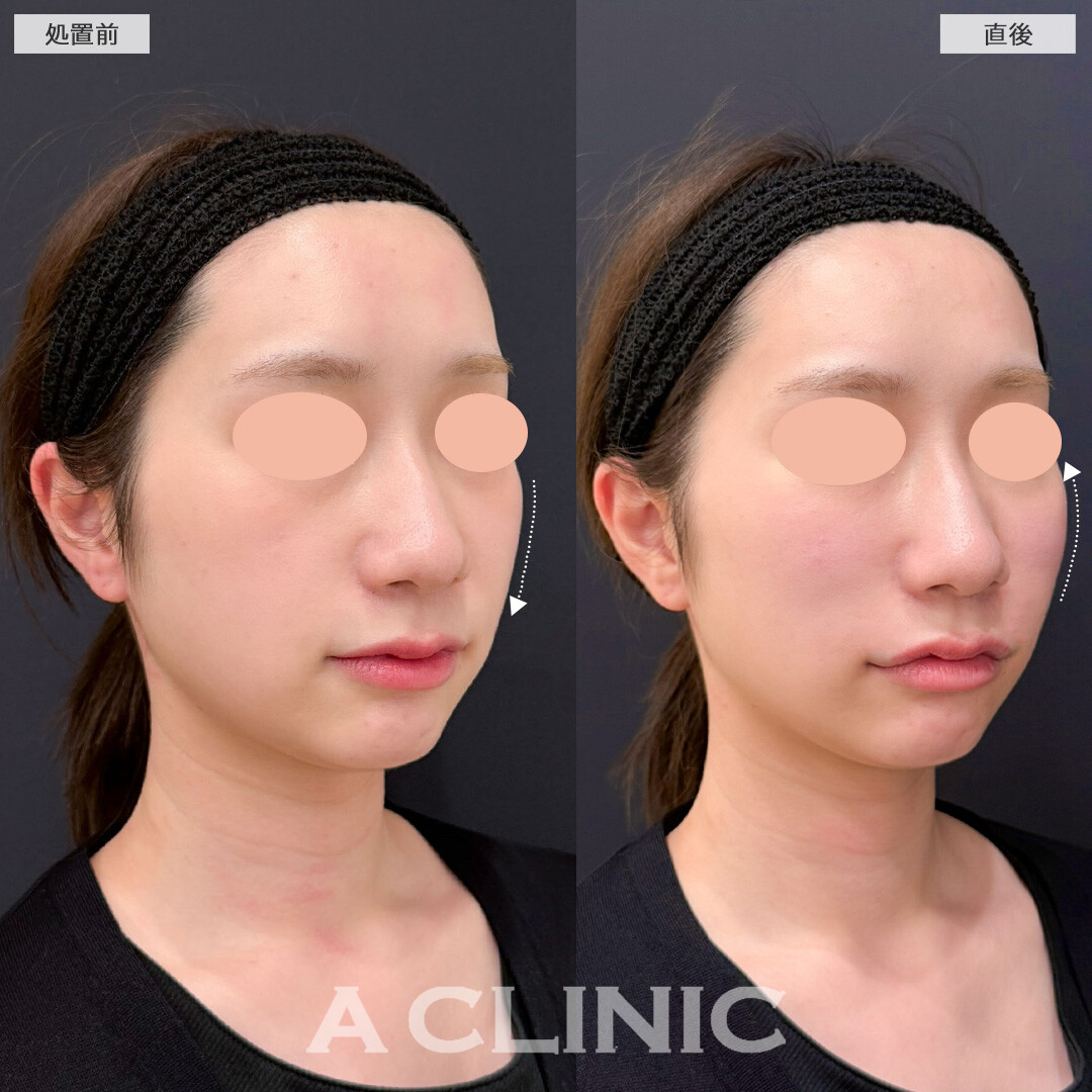 バーティカルリフトでチークトップが持ち上げ中顔面短縮しながら立体的な印象に！こちら処置前と直後の症例です(20代女性)
