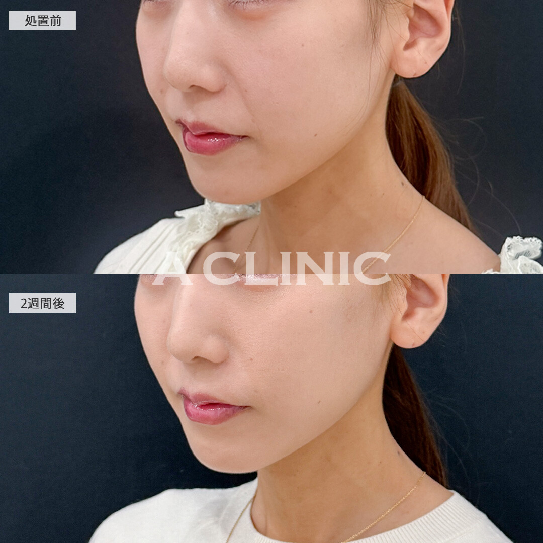 Aスレッドとバーティカルリフトで中顔面短縮！こちら処置前と2週間後の症例です(30代女性)