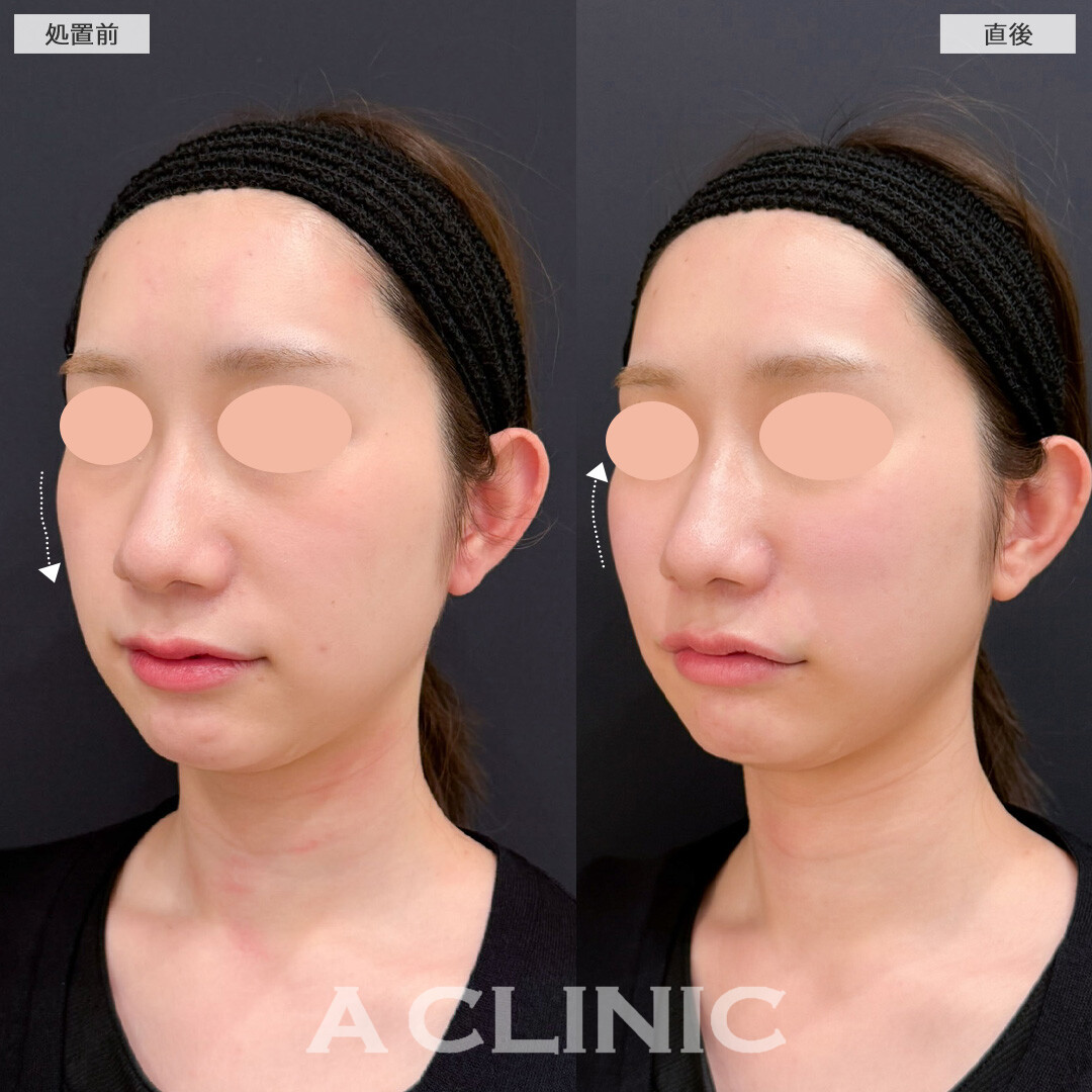 バーティカルリフトでチークトップが持ち上げ中顔面短縮しながら立体的な印象に！こちら処置前と直後の症例です(20代女性)
