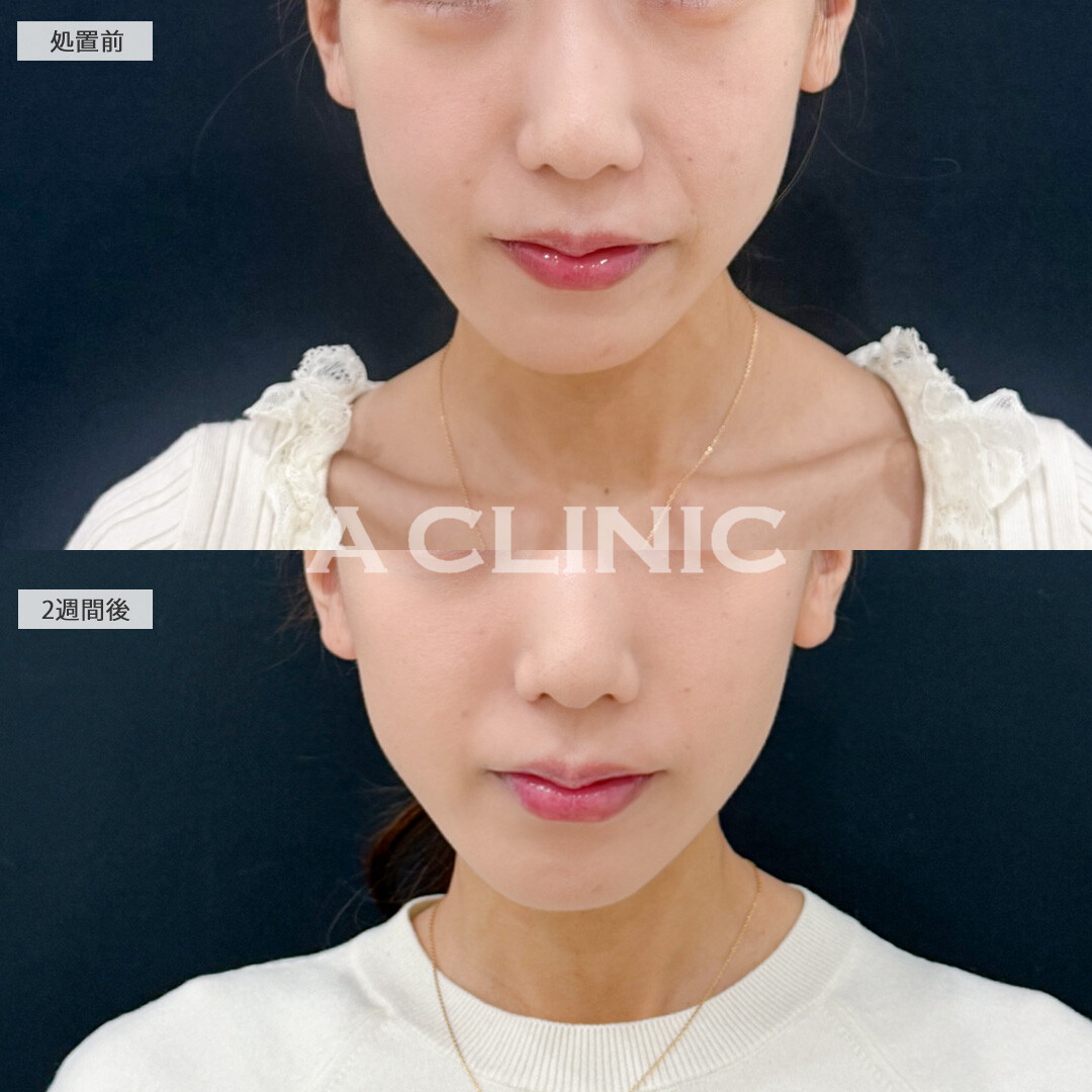 Aスレッドとバーティカルリフトで中顔面短縮！こちら処置前と2週間後の症例です(30代女性)