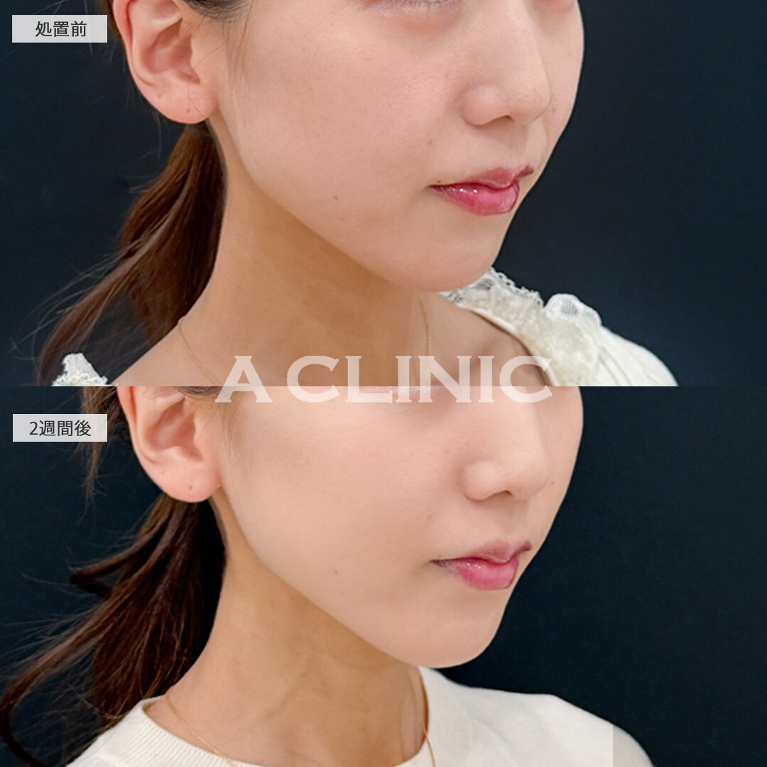 Aスレッドとバーティカルリフトで中顔面短縮！こちら処置前と2週間後の症例です(30代女性)